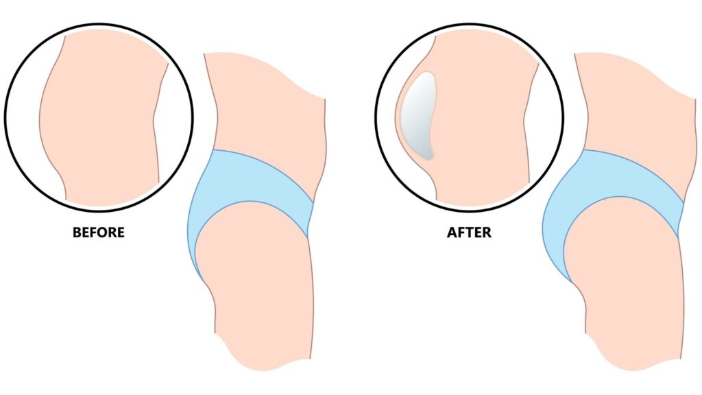 صورة قبل وبعد لمؤخرة أنثى توضح الفرق في الشكل بعد الحقن.