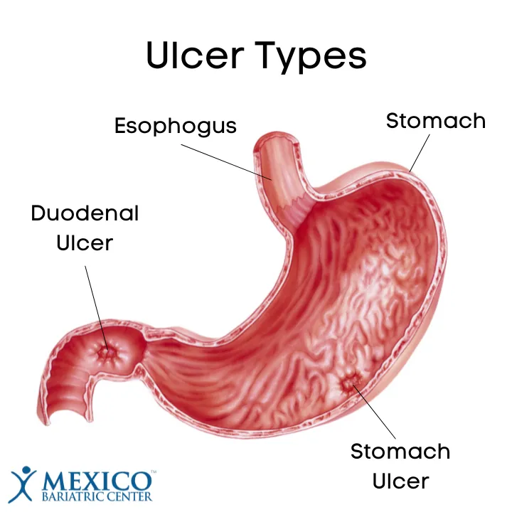 قرح المعدة (Marginal Ulcers)