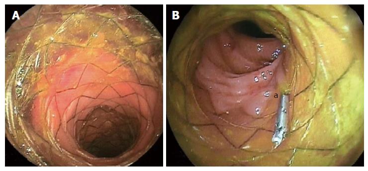 التسرب التفاغري (Anastomotic Leak)