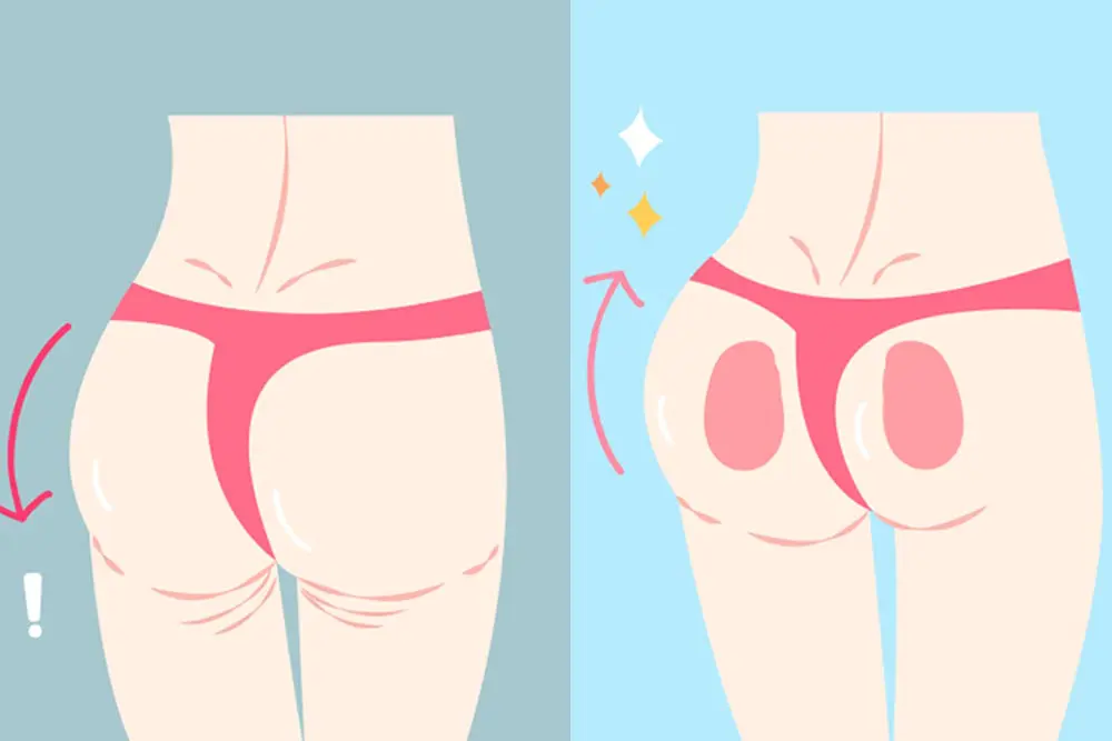 فيلر البكيني