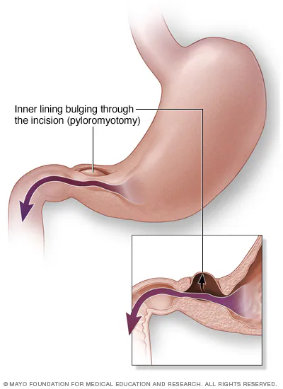 التضيق التفاغري (Anastomotic Stricture)