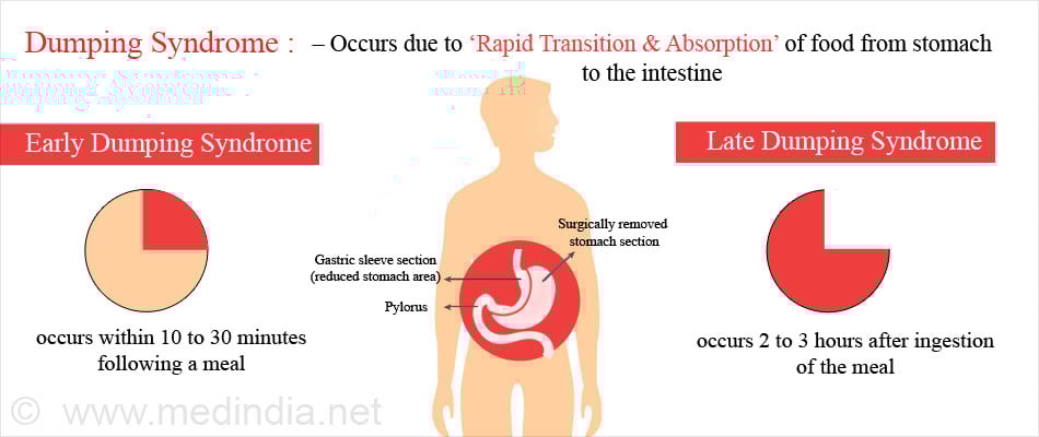 متلازمة الإغراق السريع (Dumping Syndrome)