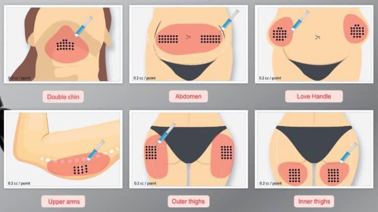 حقن الدهون الذاتية في مناطق الجسم المختلفة