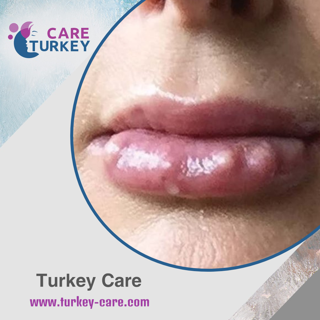 علاج تكتل الفلر