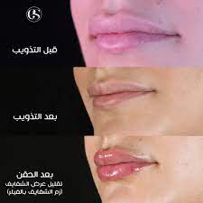 صورة "قبل وبعد" لامرأة: في الأولى بعد إذابة الفيلر والجلد طبيعي، وفي الثانية إعادة الحقن بشكل متوازن.