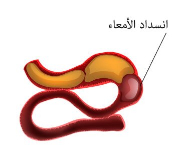 انسداد الأمعاء (Bowel Obstruction)