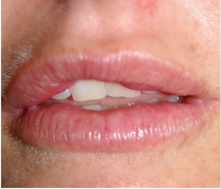 مظهر فيلر فيلر غير طبيعي