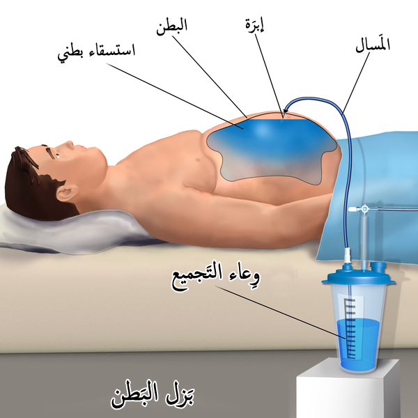 التخلص من تجمع السوائل بعد عملية شد البطن-صورة توضيحية للبطن بعد العملية مع إبراز منطقة تجمع السوائل تحت الجلد.