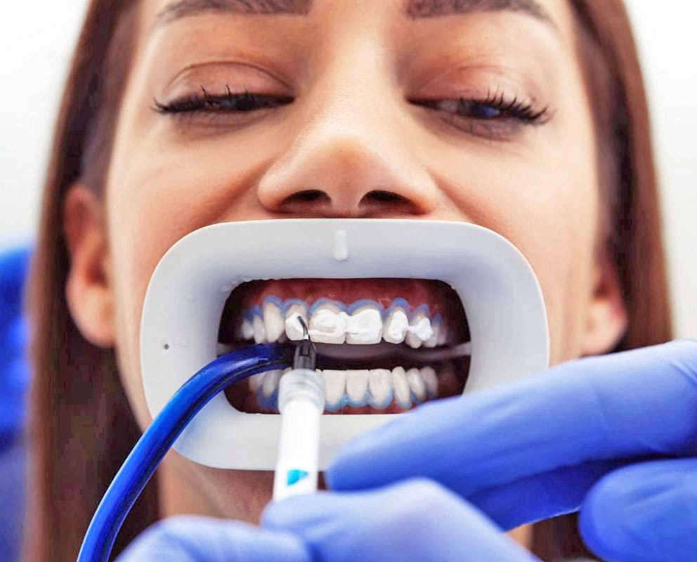 اجراء تبيض الاسنان