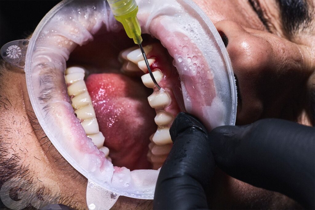 برد الأسنان 