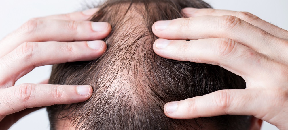 شخص يعاني من تساقط الشعر