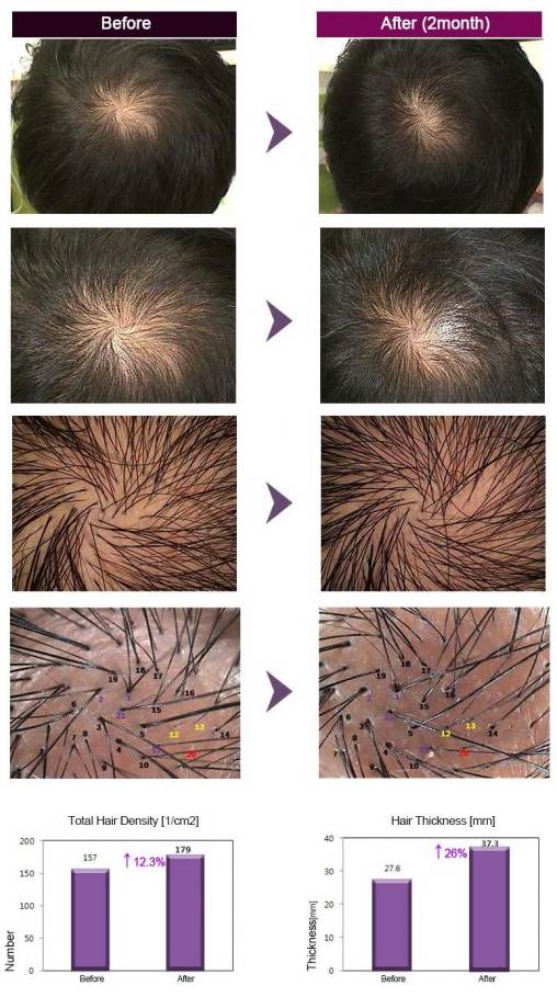 فيلر الشعر قبل و بعد
