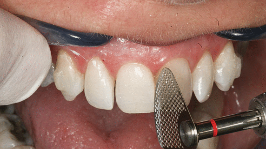 برد الاسنان 