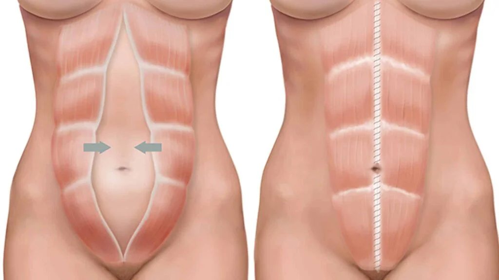 انفصال عضلي (Diastasis Recti) يترك مظهر البطن بارزًا حتى بعد الولادة.