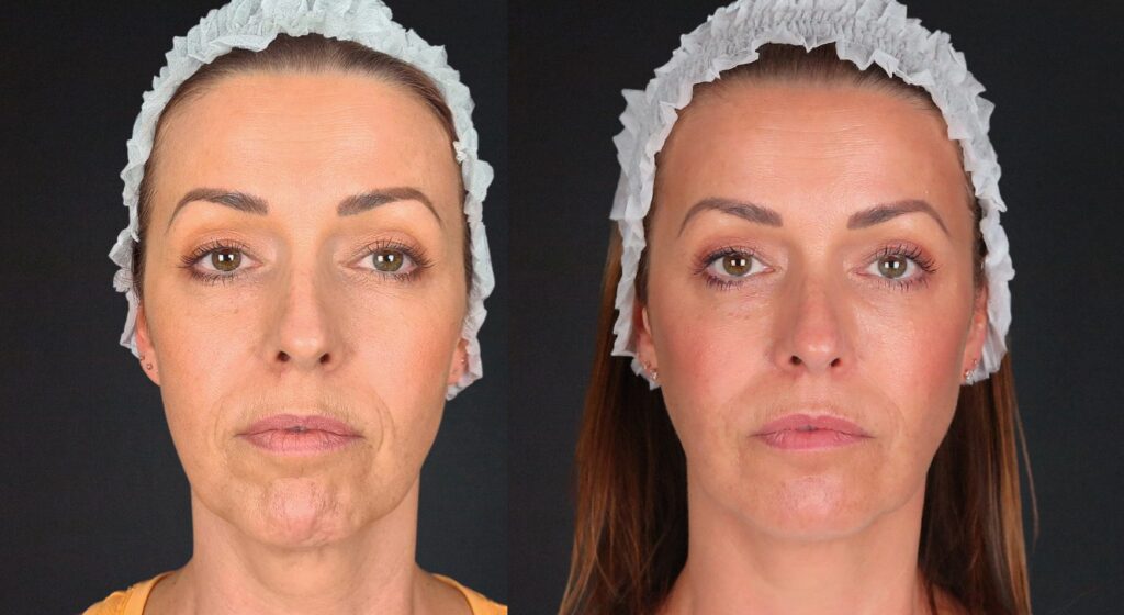 قبل و بعد فيلر الوجه النحيف