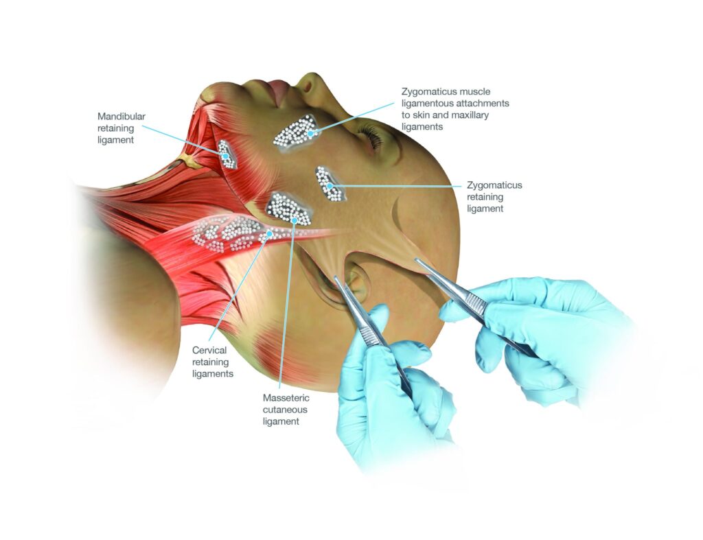 شد الرقبة بالجراحة