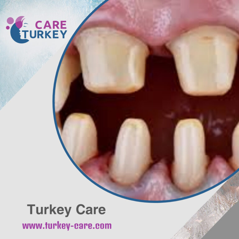 برد الاسنان