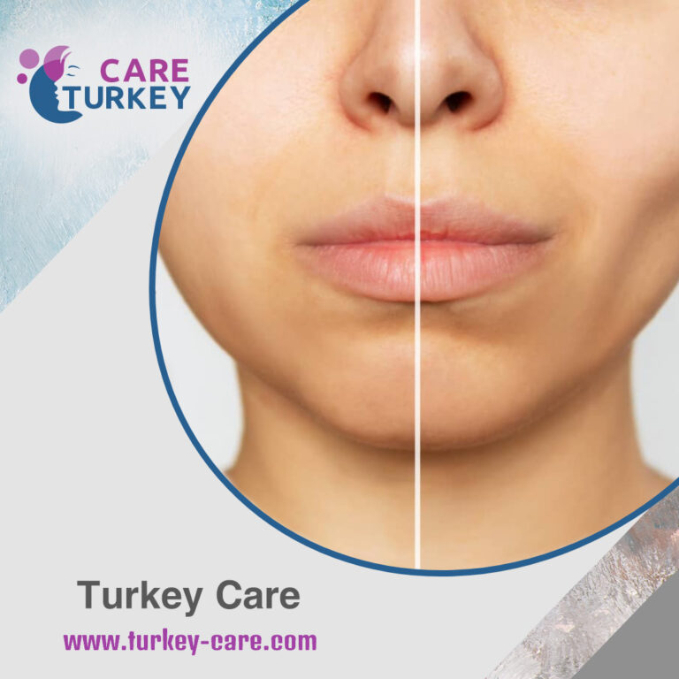 فيلر الوجه النحيف