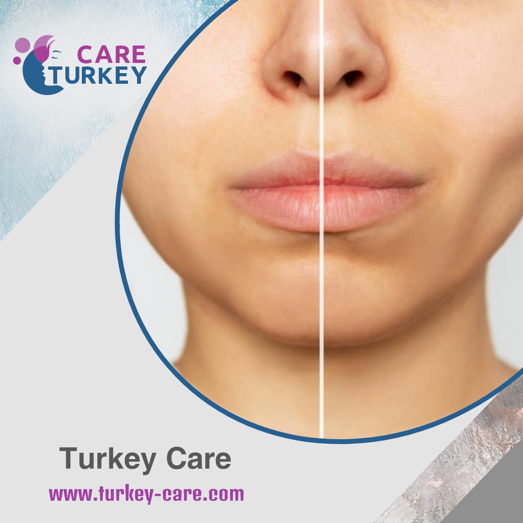 فيلر الوجه النحيف