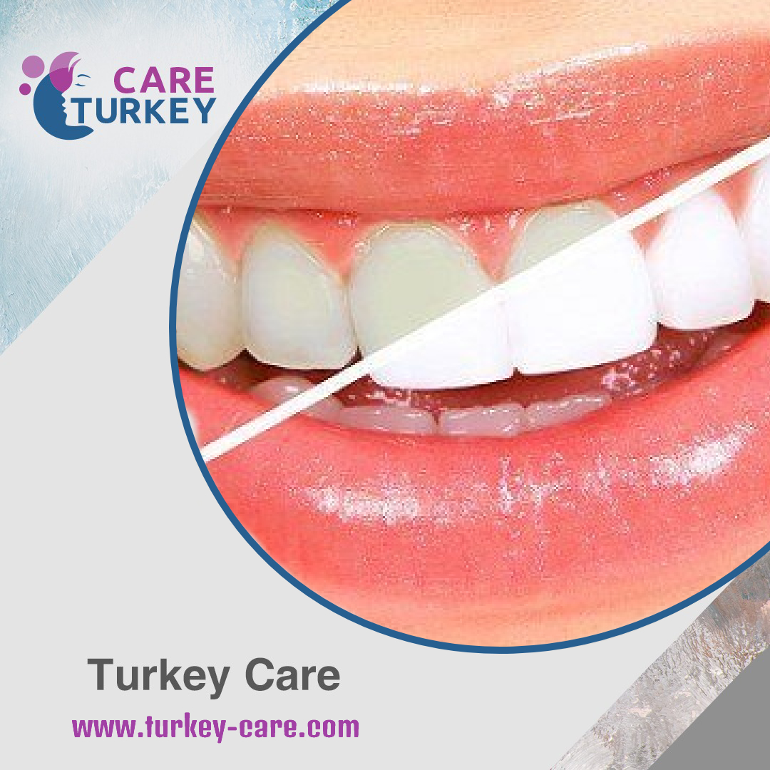 تبيض الاسنان