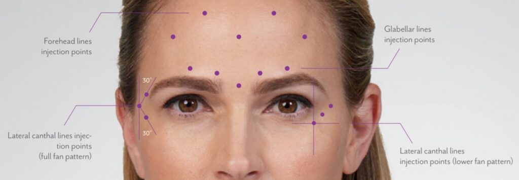 بوتوكس الجبهة في تركيا -صورة توضيحية لعضلات الجبهة مع إبراز أماكن الحقن بالبوتوكس.