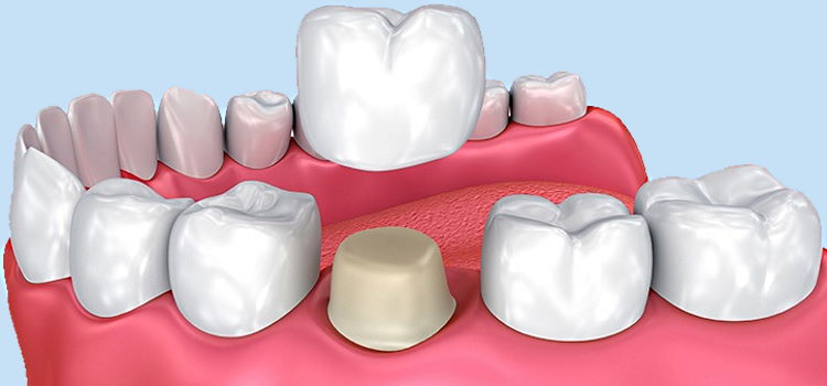 التيجان أو التلبيسات
