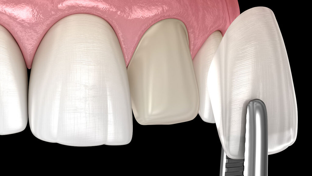 مدونة تجميل الاسنان في تركيا 