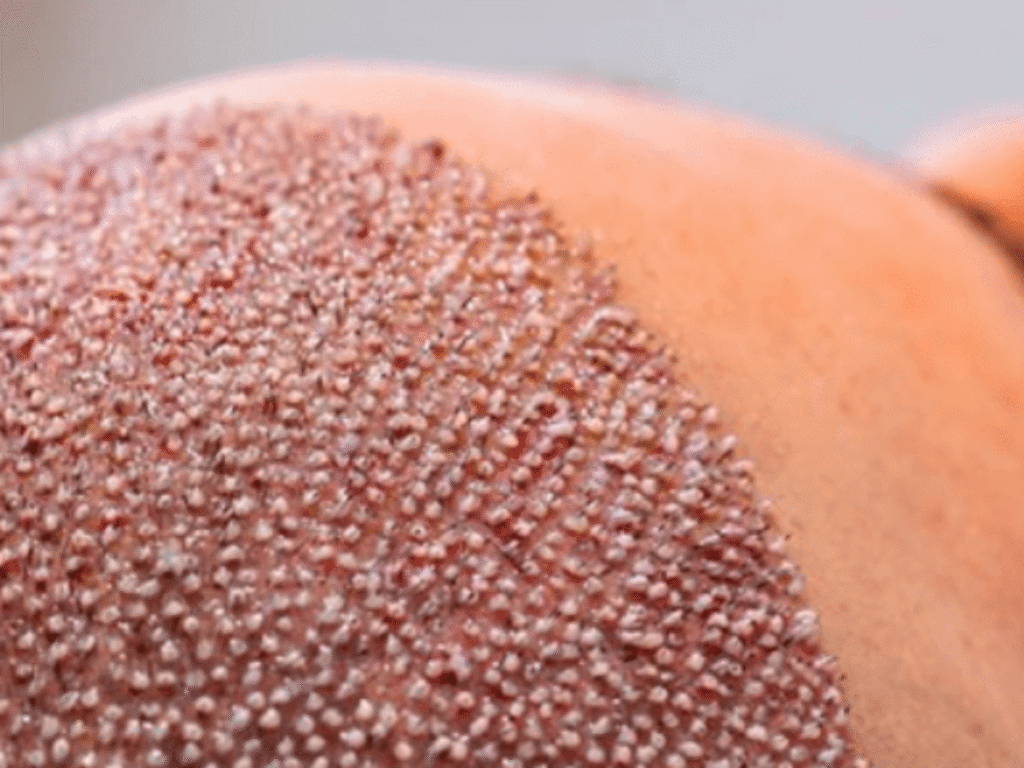 تقنية أقلام السفير لزراعة الشعر