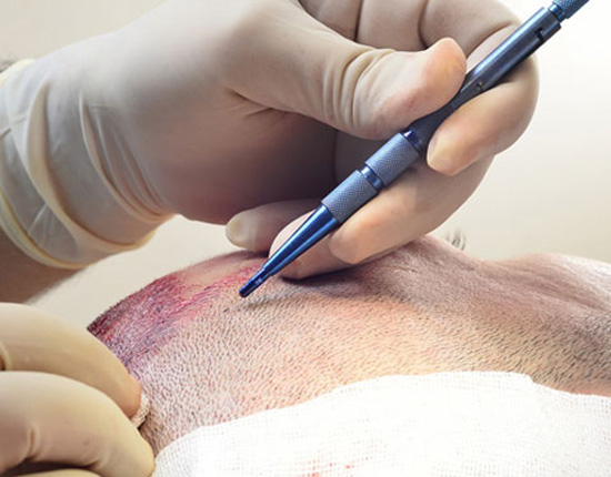 تقنية أقلام السفير لزراعة الشعر