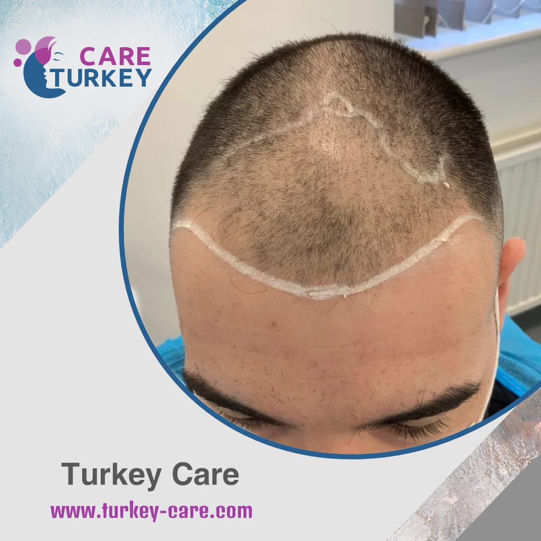 the-right-time-for-a-hair-transplant