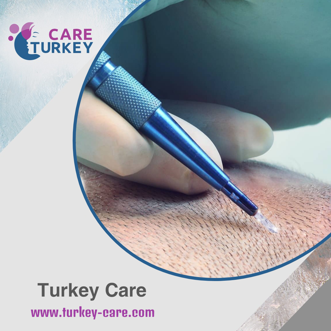 تقنية أقلام السفير لزراعة الشعر