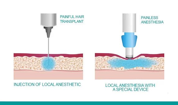 التخدير قبل زراعة الشعر