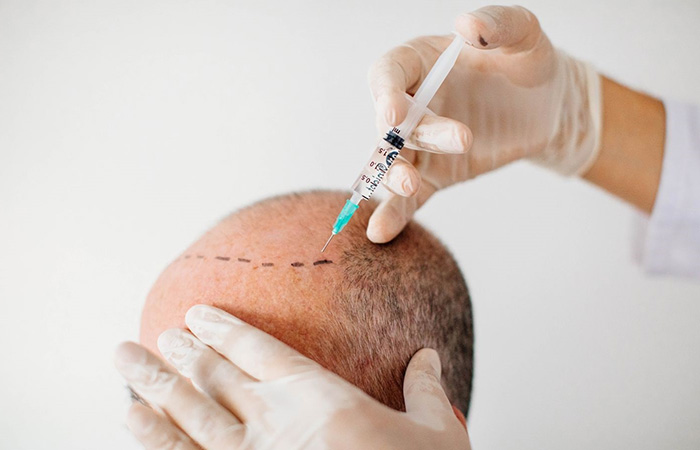 التخدير قبل زراعة الشعر