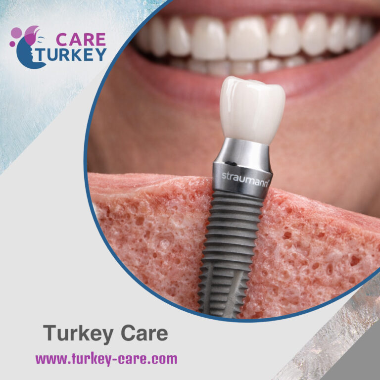 مميزات وعيوب زرعات الأسنان ستراومان