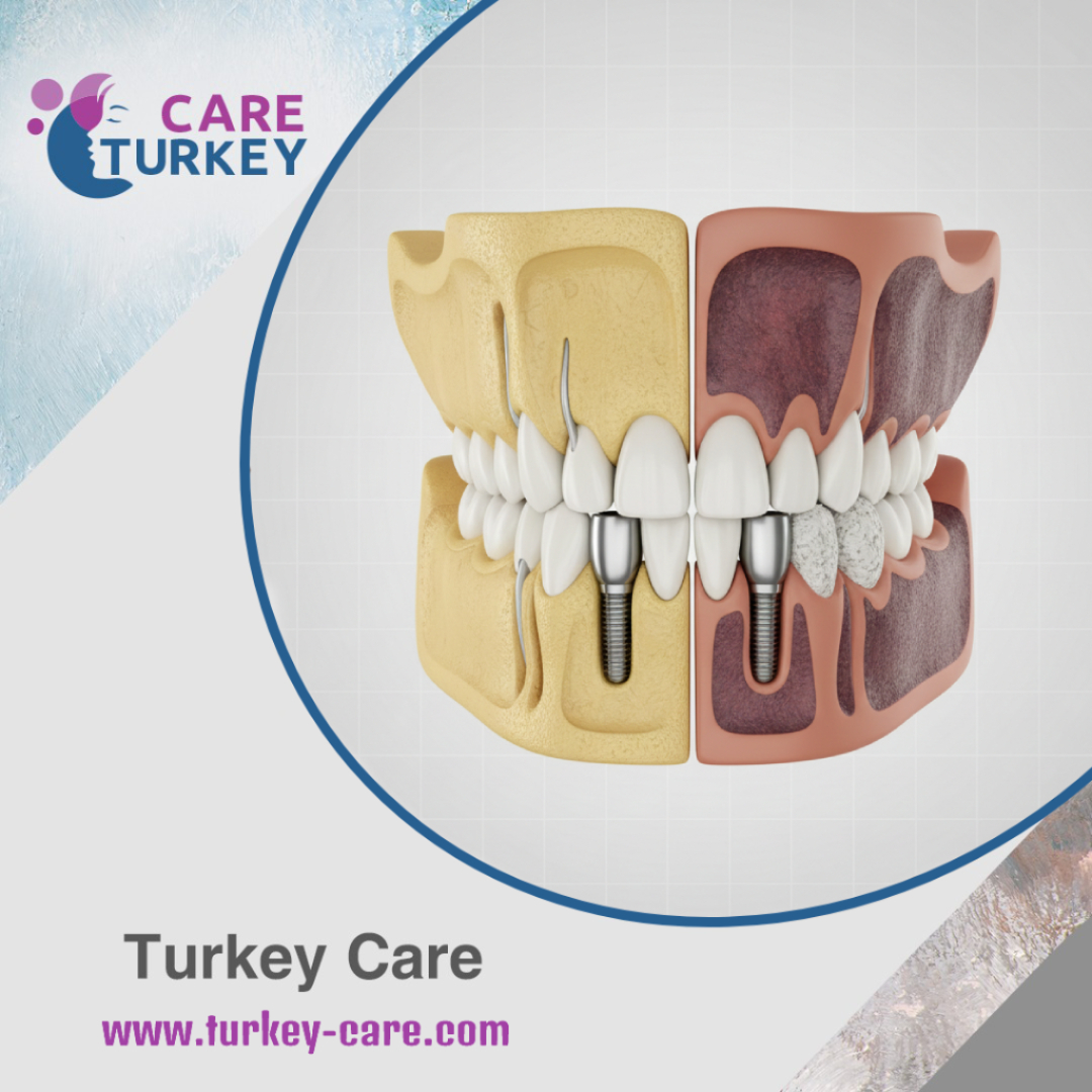 زراعة الأسنان للحالات الصعبة (مدخنين – السكري – العظم ضعيف)