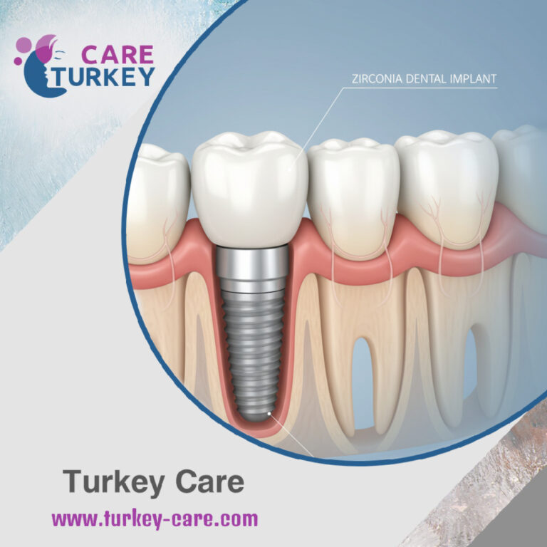 زراعة الأسنان بالزيركون