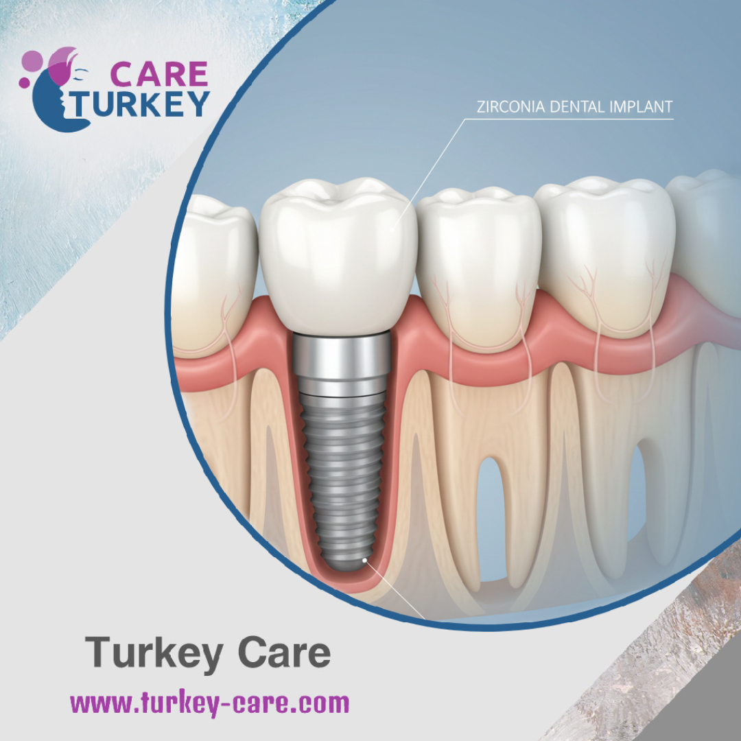 زراعة الأسنان بالزيركون