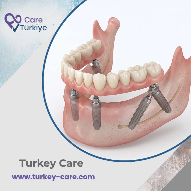 زراعة الأسنان بتقنية All-on-4