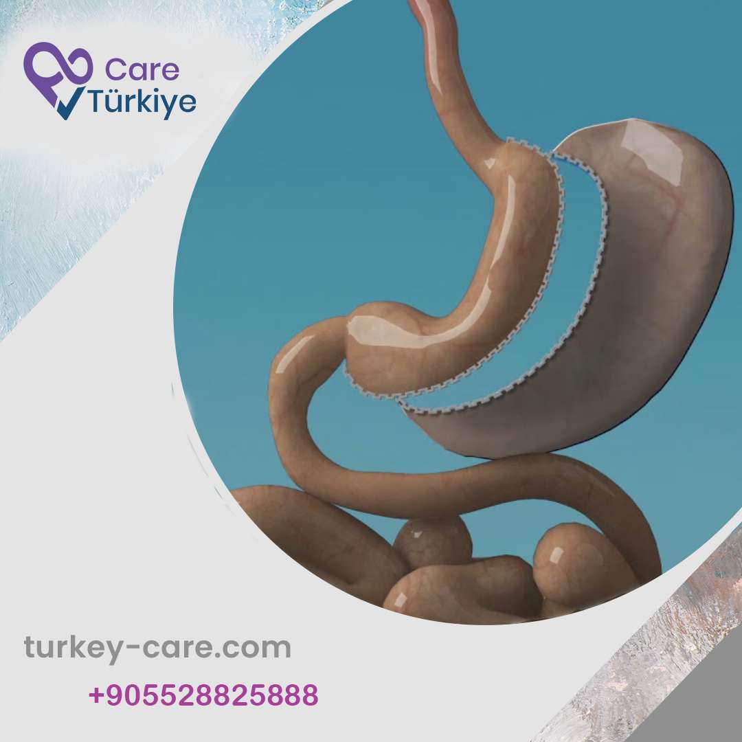 إعادة تكميم المعدة