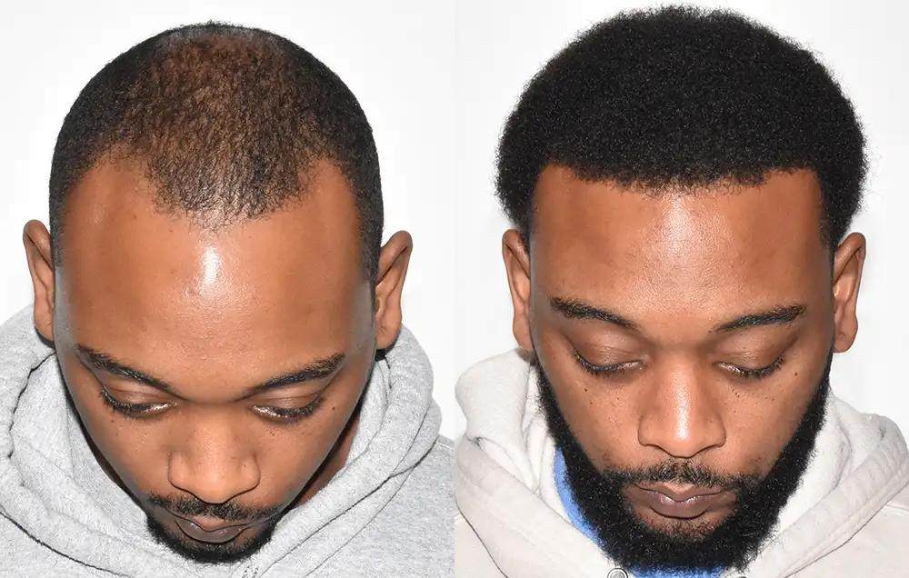 Finasteride بعد زراعة الشعر