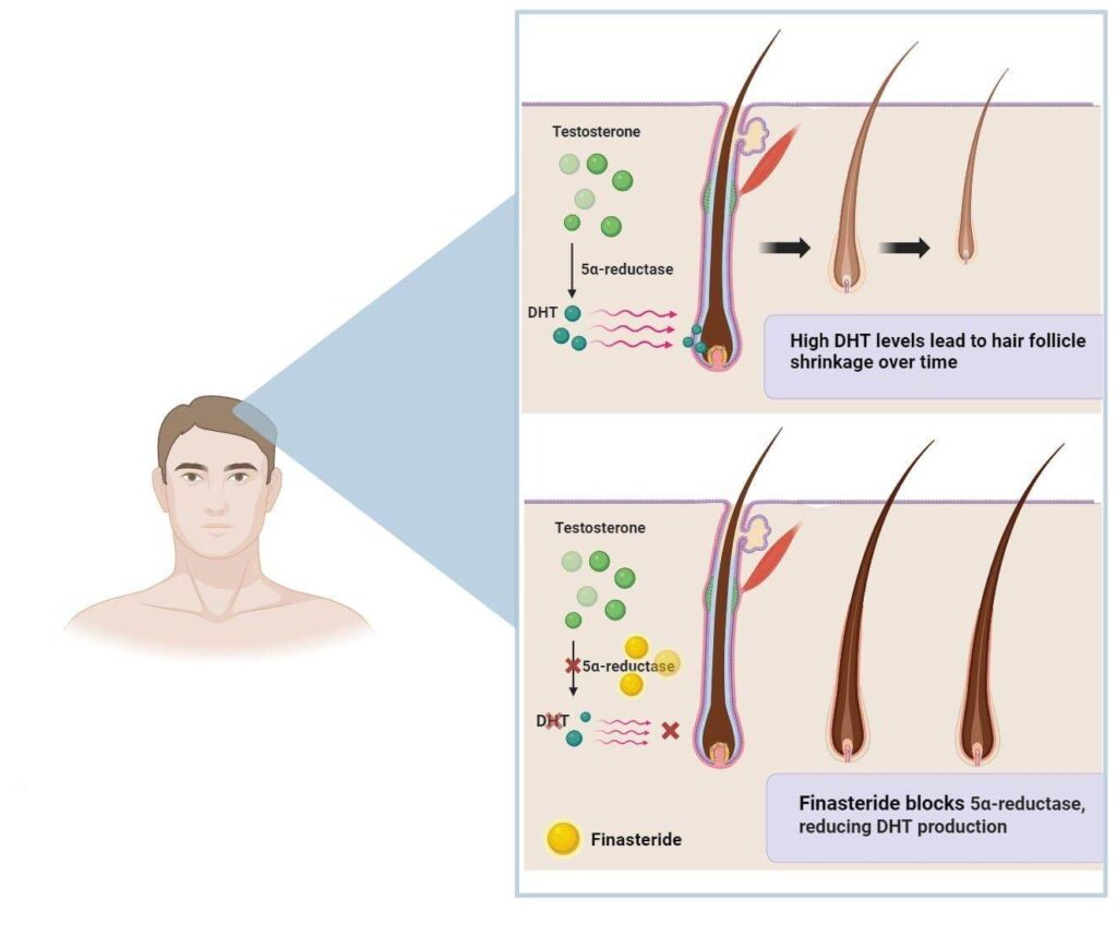 Finasteride بعد زراعة الشعر