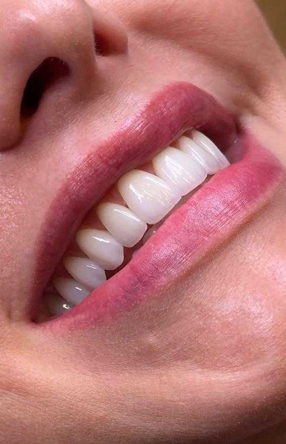 كم تدوم ابتسامة هوليوود
