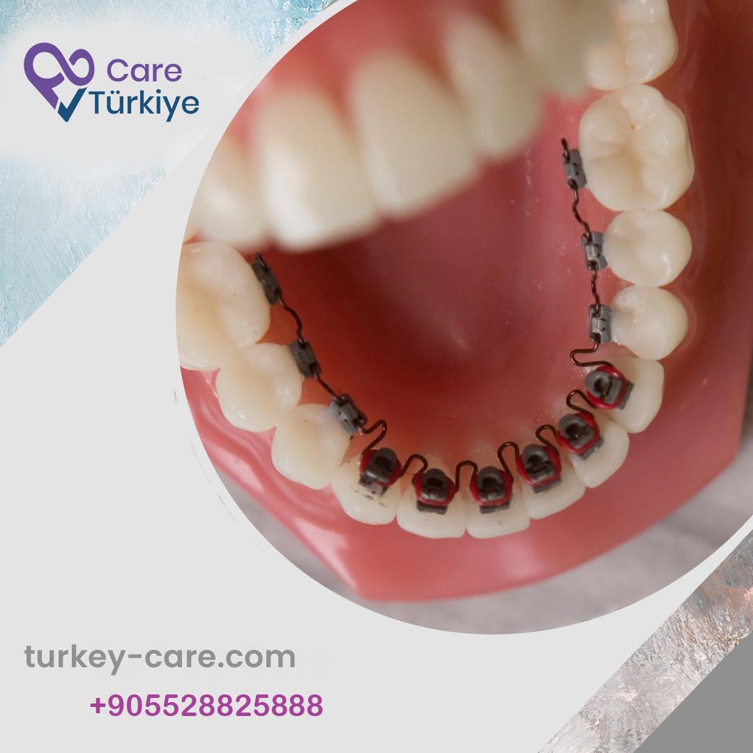 lingual-braces