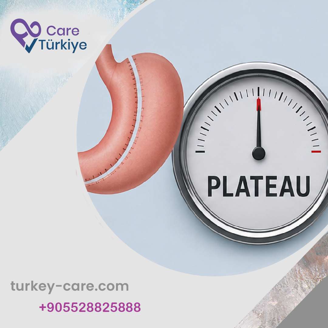 ثبات الوزن بعد تكميم المعدة (Plateau)