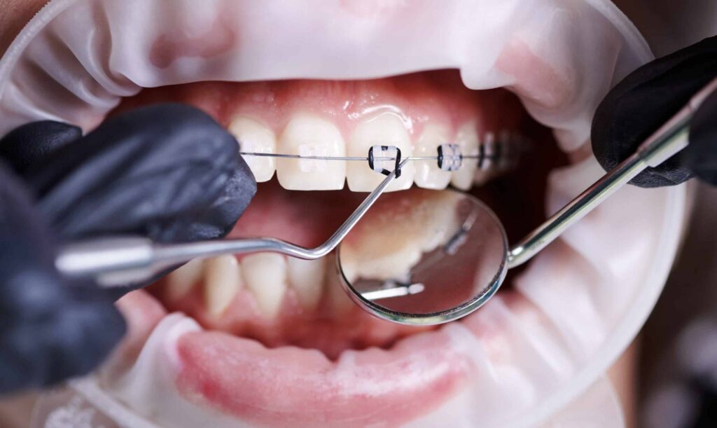 تقويم الاسنان في تركيا-teeth-braces-in-turkey