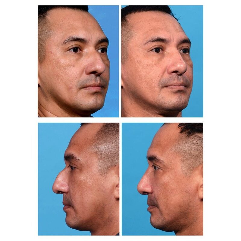 تجميل الأنف العربي