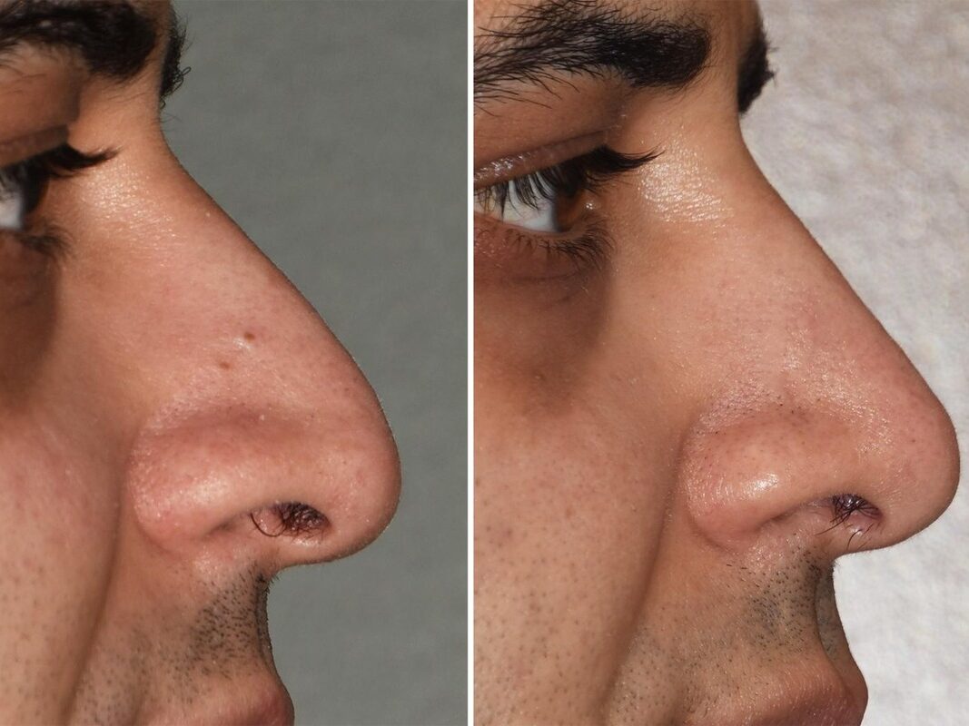 تجميل الأنف العربي