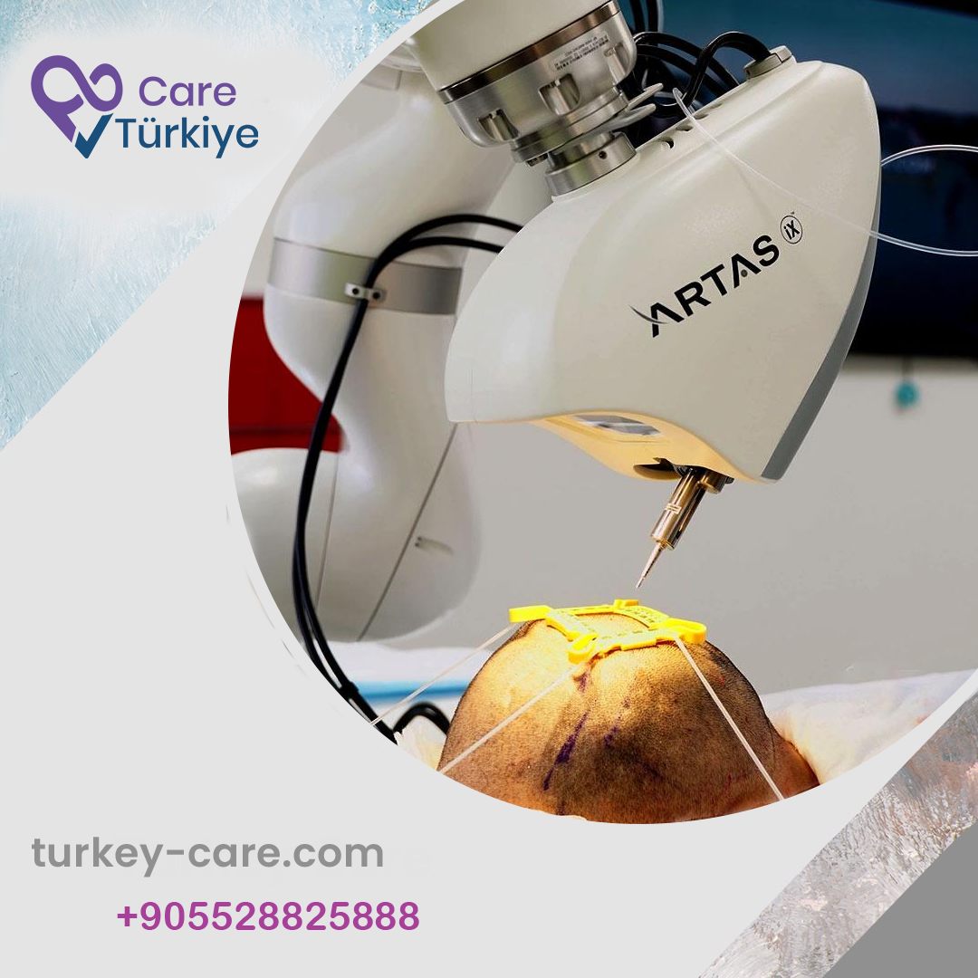 زراعة الشعر بالروبوت ARTAS