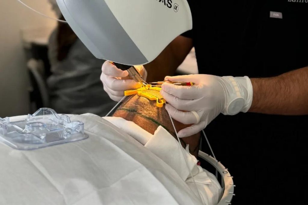 زراعة الشعر بالروبوت ARTAS