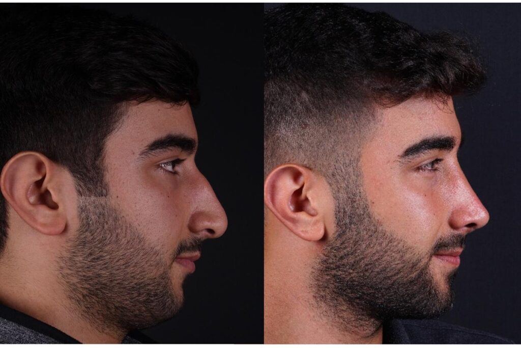 تجميل الأنف للرجال